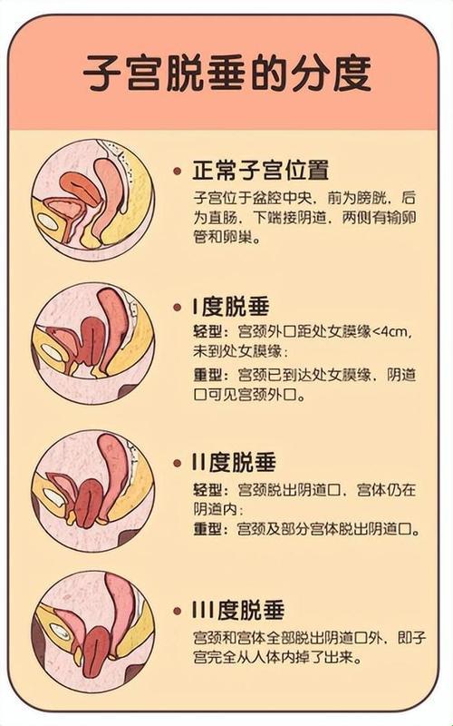 瓦萨尔瓦动作后子宫脱垂：崛起的新星