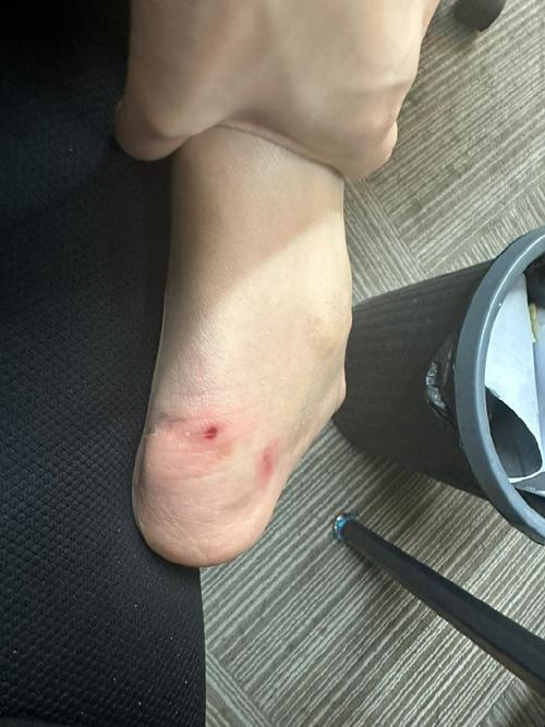 2025年运动防护科技深度解析:基于生物力学模型的足部压力缓释方案