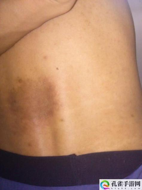 2025年腰椎代偿机制破解与智能护腰系统深度解析